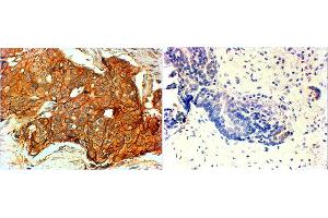 ABIN4902619 (4µg/ml) staining of paraffin embedded Human breast cancer (Her+ left, triple negative right). (ErbB2/Her2 antibody)