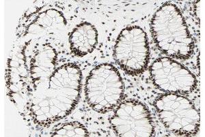 ABIN6267281 at 1/200 staining human colon carcinoma sections by IHC-P. (RAF1 antibody  (pSer259))