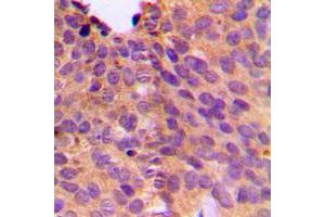 Immunohistochemical analysis of NT5C1B staining in human breast cancer formalin fixed paraffin embedded tissue section. (NT5C1B antibody  (Center))