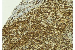 ABIN6273779 at 1/100 staining Human breast cancer tissue by IHC-P.