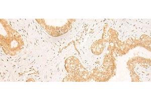 Immunohistochemistry of paraffin-embedded Human breast cancer tissue using GSG1L Polyclonal Antibody at dilution of 1:50(x200)