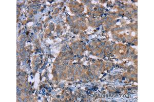 Immunohistochemistry of Human breast cancer using PON1 Polyclonal Antibody at dilution of 1:40 (PON1 antibody)