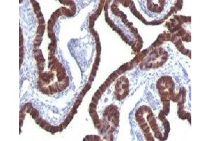 Formalin-fixed, paraffin-embedded human ovarian carcinoma stained with Cytokeratin 7 antibody (KRT7/760) (Cytokeratin 7 antibody)