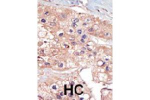 Formalin-fixed and paraffin-embedded human hepatocellular carcinoma tissue reacted with UHMK1 polyclonal antibody  , which was peroxidase-conjugated to the secondary antibody, followed by DAB staining. (UHMK1 antibody  (N-Term))