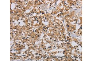 Immunohistochemistry of Human liver cancer using INPPL1 Polyclonal Antibody at dilution of 1:40 (INPPL1 antibody)