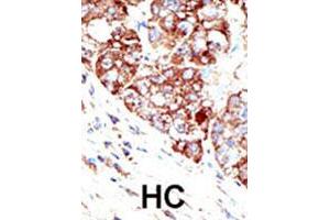 Formalin-fixed and paraffin-embedded human hepatocellular carcinoma tissue reacted with PIAS1 polyclonal antibody , which was peroxidase-conjugated to the secondary antibody, followed by DAB staining. (PIAS1 antibody  (C-Term))