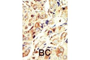 Formalin-fixed and paraffin-embedded human cancer tissue reacted with IGF1R polyclonal antibody  , which was peroxidase-conjugated to the secondary antibody, followed by DAB staining. (IGF1R antibody  (N-Term))