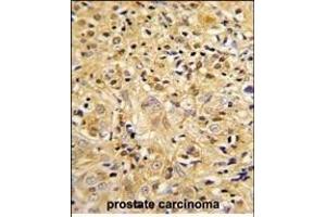 Formalin-fixed and paraffin-embedded human prostate carcinoma reacted with LUM Antibody (Center), which was peroxidase-conjugated to the secondary antibody, followed by DAB staining. (LUM antibody  (AA 198-227))