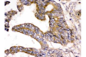 WNK1 was detected in paraffin-embedded sections of human intestinal cancer tissues using rabbit anti-WNK1 Antigen Affinity purified polyclonal antibody (Catalog # ) at 1 µg/mL. (WNK1 antibody  (Middle Region))