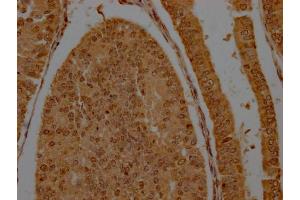 IHC image of ABIN7154444 diluted at 1:200 and staining in paraffin-embedded human endometrial cancer performed on a Leica BondTM system.