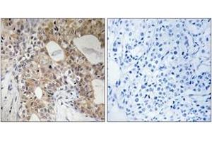 Immunohistochemistry analysis of paraffin-embedded human breast carcinoma, using SPHK2 (Phospho-Thr614) Antibody. (SPHK2 antibody  (pThr614))