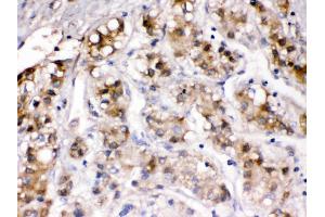 Ceruloplasmin was detected in paraffin-embedded sections of human liver cancer tissues using rabbit anti- Ceruloplasmin Antigen Affinity purified polyclonal antibody at 1 μg/mL. (Ceruloplasmin antibody  (AA 20-259))