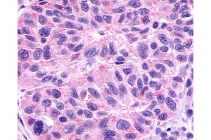 Anti-GPR78 antibody IHC of human Skin, Melanoma. (GPR78 antibody  (Cytoplasmic Domain))