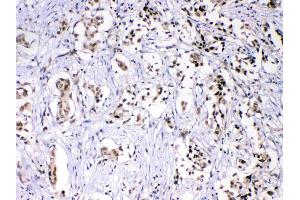 HnRNPF was detected in paraffin-embedded sections of human mammary cancer tissues using rabbit anti- HnRNPF Antigen Affinity purified polyclonal antibody (Catalog # ) at 1 µg/mL. (HNRNPF antibody  (N-Term))