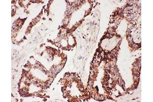 IHC-P: CNTF antibody testing of human lung cancer tissue (CNTF antibody  (AA 2-200))
