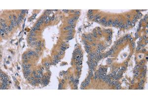 Immunohistochemistry of paraffin-embedded Human colon cancer tissue using KIAA1324 Polyclonal Antibody at dilution 1:30 (ELAPOR1 antibody)