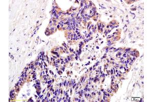 Formalin-fixed and paraffin embedded human colon carcinoma labeled with Anti-XAGE2 Polyclonal Antibody, Unconjugated (ABIN721750) at 1:200 followed by conjugation to the secondary antibody and DAB staining. (XAGE2 antibody  (AA 30-70))