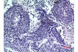 Immunohistochemistry (IHC) analysis of paraffin-embedded Human Lung Cancer, antibody was diluted at 1:100. (PDGFD antibody  (C-Term))