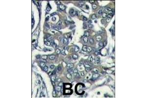 Formalin-fixed and paraffin-embedded human breast carcinoma reacted with EIF4E2 Antibody (N-term) (ABIN388676 and ABIN2838643) , which was peroxidase-conjugated to the secondary antibody, followed by DAB staining. (EIF4E2 antibody  (N-Term))