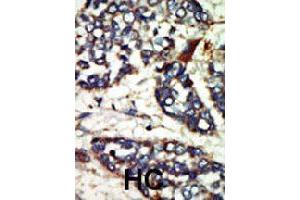 Formalin-fixed and paraffin-embedded human hepatocellular carcinoma tissue reacted with NEK1 polyclonal antibody  , which was peroxidase-conjugated to the secondary antibody, followed by DAB staining. (NEK1 antibody  (C-Term))