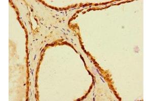 Immunohistochemistry of paraffin-embedded human prostate cancer using ABIN7151711 at dilution of 1:100