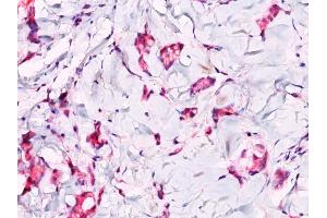 Formalin-fixed, paraffin-embedded breast lobular carcinoma stained with Catenin, beta PAb. (CTNNB1 antibody)