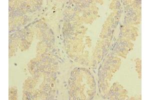 Immunohistochemistry of paraffin-embedded human prostate cancer using ABIN7171826 at dilution of 1:100 (Twisted Gastrulation BMP Signaling Modulator 1a (TWSG1A) (AA 1-200) antibody)