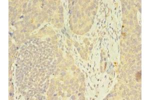 Immunohistochemistry of paraffin-embedded human gastric cancer using ABIN7162815 at dilution of 1:100 (FKBP11 antibody  (AA 28-154))