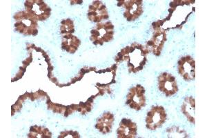 Formalin-fixed, paraffin-embedded human Breast Carcinoma stained with TFF1/pS2 Mouse Monoclonal Antibody (rTFF1/1091). (Recombinant TFF1 antibody)