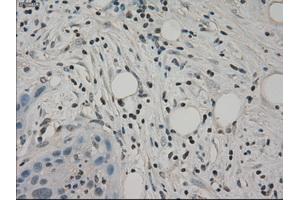 Immunohistochemical staining of paraffin-embedded Carcinoma of pancreas tissue using anti-SLC2A5mouse monoclonal antibody. (SLC2A5 antibody)