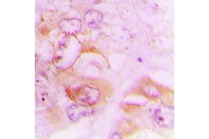 Immunohistochemical analysis of Septin 7 staining in human lung cancer formalin fixed paraffin embedded tissue section. (Septin 7 antibody  (C-Term))