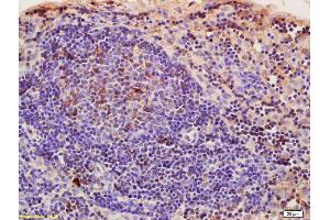 Formalin-fixed and paraffin embedded rat pancreatic cancer labeled with Anti-CRIM1 Polyclonal Antibody, Unconjugated (ABIN676853) at 1:200, followed by conjugation to the secondary antibody and DAB staining