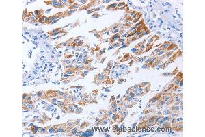 Immunohistochemistry of Human lung cancer using KIF3A Polyclonal Antibody at dilution of 1:40 (KIF3A antibody)