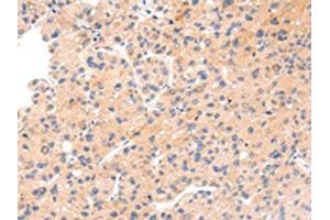 The image on the left is immunohistochemistry of paraffin-embedded Human liver cancer tissue using ABIN7191067(IKZF4 Antibody) at dilution 1/20, on the right is treated with synthetic peptide. (IKZF4 antibody)