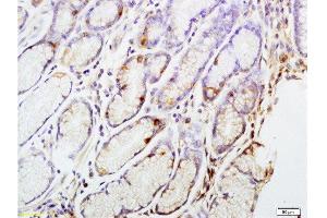Formalin-fixed and paraffin embedded human gastric carcinoma tissue labeled with Anti-CENPA Polyclonal Antibody, Unconjugated at 1:200 followed by conjugation to the secondary antibody and DAB staining