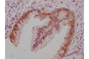 IHC image of ABIN7180837 diluted at 1:100 and staining in paraffin-embedded human pancreatic cancer performed on a Leica BondTM system. (Claudin 18 antibody)