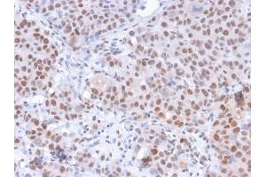 Formalin-fixed, paraffin-embedded human Colon Carcinoma stained with RNA Polymerase II / Poll II Mouse Monoclonal Antibody (8A7). (POLR2A/RPB1 antibody  (pSer5))