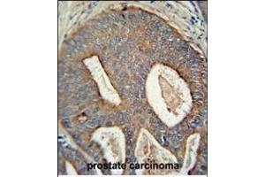 POTEB antibody (C-term) (ABIN653990 and ABIN2843930) immunohistochemistry analysis in formalin fixed and paraffin embedded human prostate carcinoma followed by peroxidase conjugation of the secondary antibody and DAB staining. (POTEB antibody  (C-Term))