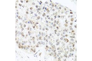 Immunohistochemistry of paraffin-embedded human lung cancer using CETN3 antibody (ABIN5974786) at dilution of 1/100 (40x lens).