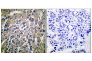Immunohistochemical analysis of paraffin-embedded human breast carcinoma tissue using hCG beta antibody (ABIN5976419). (HCG beta antibody  (C-Term))