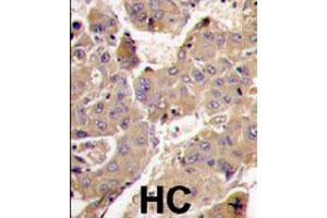 Formalin-fixed and paraffin-embedded human hepatocellular carcinoma reacted with PIK3R3 polyclonal antibody  , which was peroxidase-conjugated to the secondary antibody, followed by DAB staining. (PIK3R3 antibody  (C-Term))