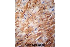 TFB2M Antibody (C-term) immunohistochemistry analysis in formalin fixed and paraffin embedded human heart carcinoma followed by peroxidase conjugation of the secondary antibody and DAB staining. (TFB2M antibody  (C-Term))
