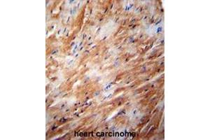 TFB2M Antibody (C-term) immunohistochemistry analysis in formalin fixed and paraffin embedded human heart carcinoma followed by peroxidase conjugation of the secondary antibody and DAB staining.