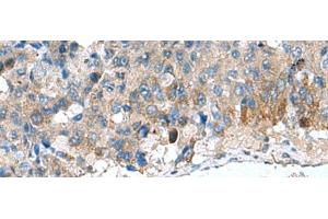 Immunohistochemistry of paraffin-embedded Human liver cancer tissue using HSD11B1 Polyclonal Antibody at dilution of 1:70(x200) (HSD11B1 antibody)