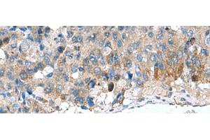 Immunohistochemistry of paraffin-embedded Human liver cancer tissue using HSD11B1 Polyclonal Antibody at dilution of 1:70(x200) (HSD11B1 antibody)