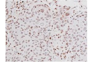 ABIN6267365 at 1/200 staining Human lung cancer tissue sections by IHC-P. (KIT antibody  (pTyr721))