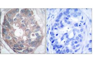 Immunohistochemical analysis of paraffin-embedded human breast carcinoma tissue, using Dab1 (Ab-232) antibody (E021251). (DAB1 antibody)
