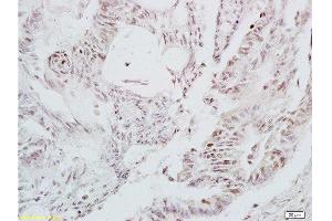 Formalin-fixed and paraffin embedded human colon carcinoma tissue labeled with Anti-LEF-1 Polyclonal Antibody, Unconjugated at 1:200 followed by conjugation to the secondary antibody and DAB staining (LEF1 antibody  (AA 331-399))