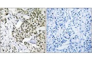 Immunohistochemistry analysis of paraffin-embedded human breast carcinoma tissue, using CAGE1 Antibody.