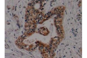 Detection of ERa in Human Breast cancer Tissue using Polyclonal Antibody to Estrogen Receptor Alpha (ERa) (Estrogen Receptor alpha antibody  (AA 178-438))